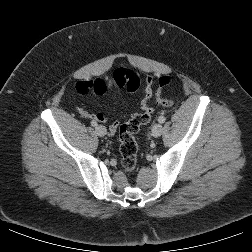 Burned-out testicular seminoma - retroperitoneal nodal metastases (Radiopaedia 62872-71245 A 60).jpg