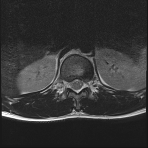 File:Burst fracture - T12 with conus compression (Radiopaedia 56825-63646 Axial T2 17).png