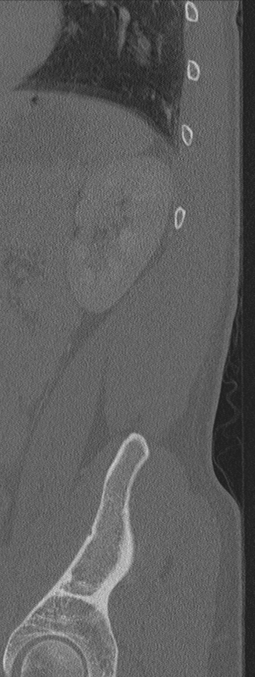 Burst fracture - T12 with conus compression (Radiopaedia 56825-63647 Sagittal bone window 2).png