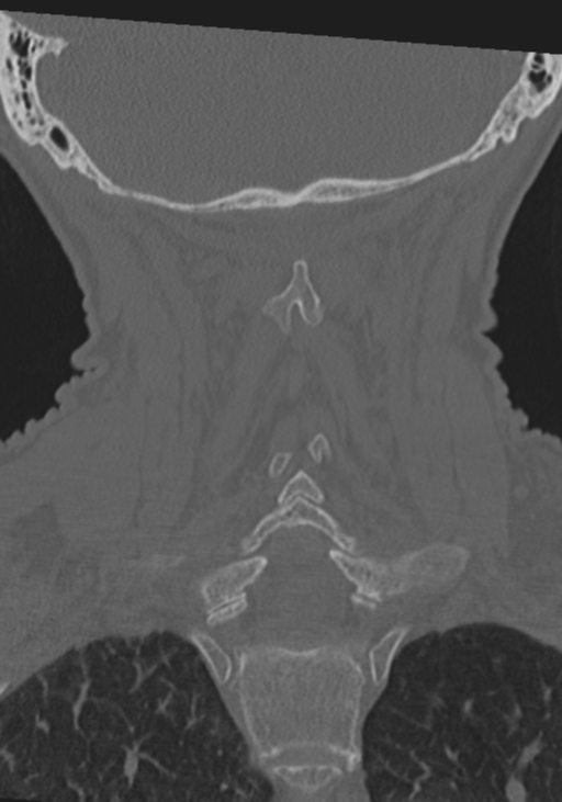 C2 fracture with vertebral artery dissection (Radiopaedia 37378-39199 Coronal bone window 37).png
