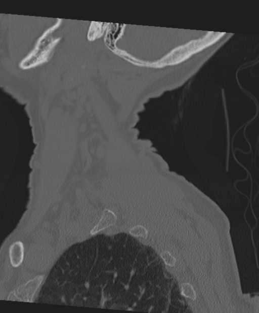 C2 fracture with vertebral artery dissection (Radiopaedia 37378-39199 Sagittal bone window 12).png