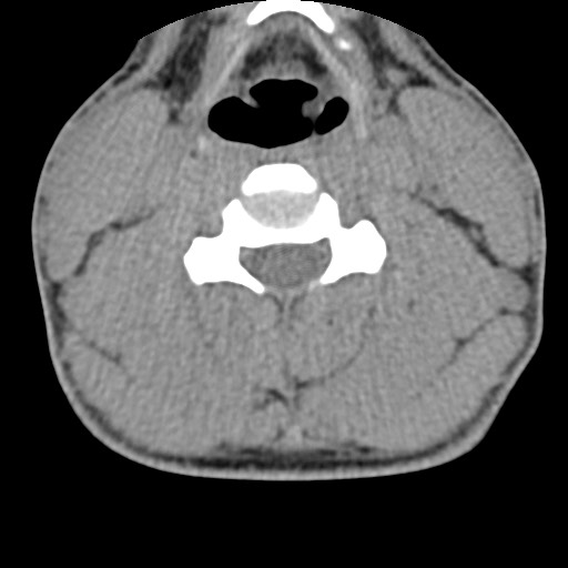 C5 facet fracture (Radiopaedia 58374-65499 Axial non-contrast 50).jpg