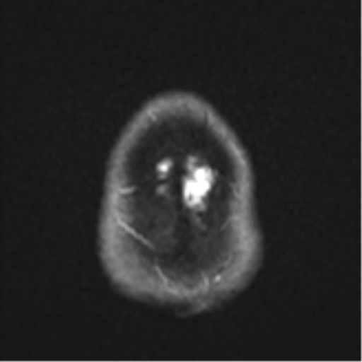 File:CNS vasculitis (Radiopaedia 55715-62263 Axial DWI 29).png