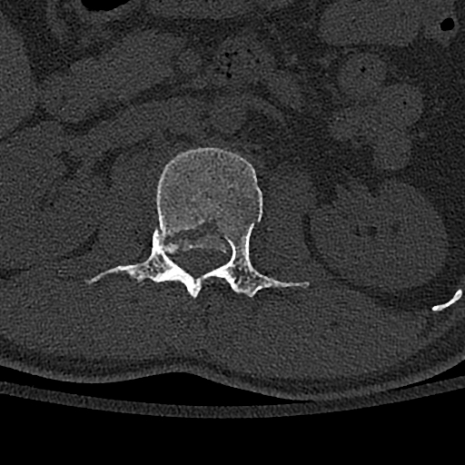 Calcaneal fractures with associated L2 burst fracture (Radiopaedia 71671-82493 Axial bone window 37).jpg