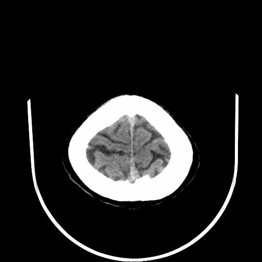 File:Calcification of the falx cerebri (Radiopaedia 21803).jpg