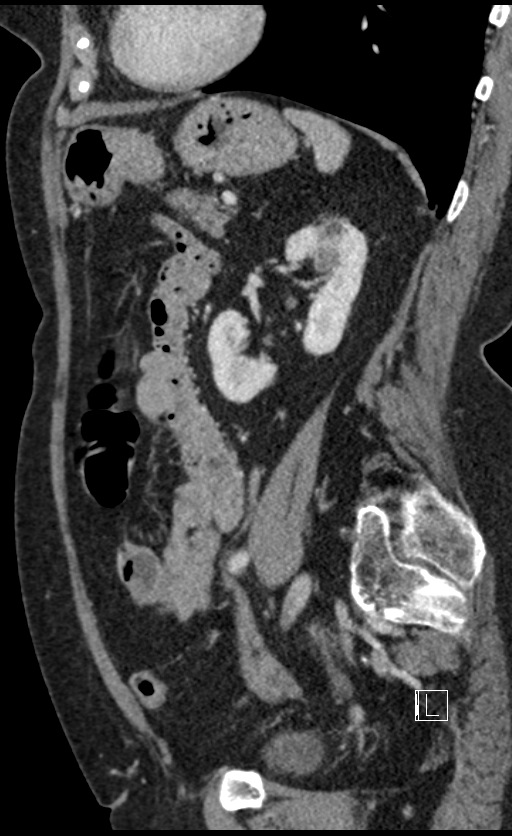 Calcified adrenal glands and Spigelian hernia (Radiopaedia 49741-54988 C 53).jpg