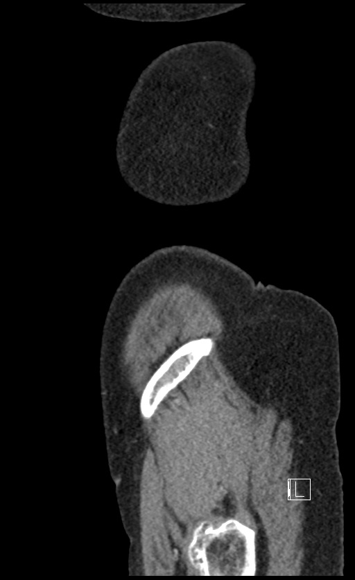 Calcified adrenal glands and Spigelian hernia (Radiopaedia 49741-54988 C 7).jpg