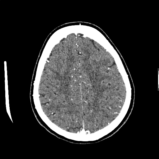 Calcified cerebral hydatid cyst (Radiopaedia 65603-74717 Axial with contrast 60).jpg