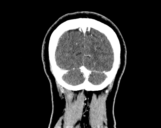 Calcified cerebral hydatid cyst (Radiopaedia 65603-74717 C 68).jpg