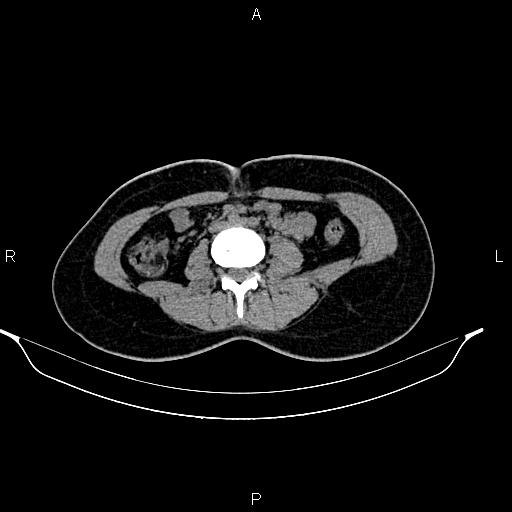 File:Calcified hepatic hydatid cyst (Radiopaedia 84672-100095 Axial non-contrast 65).jpg