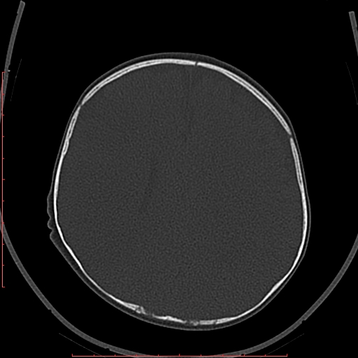 Calcified middle cerebral artery embolism (Radiopaedia 78949-91860 Axial bone window 45).jpg