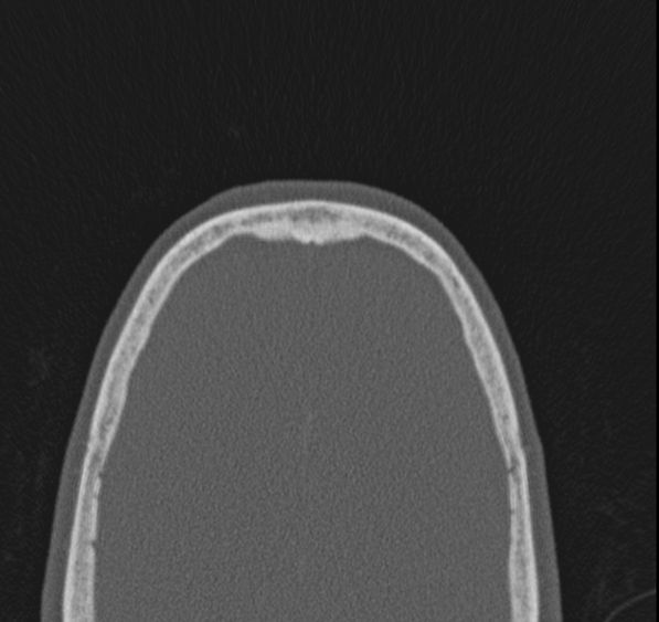 Caldwell-Luc operation (Radiopaedia 52329-58225 Axial bone window 1).jpg