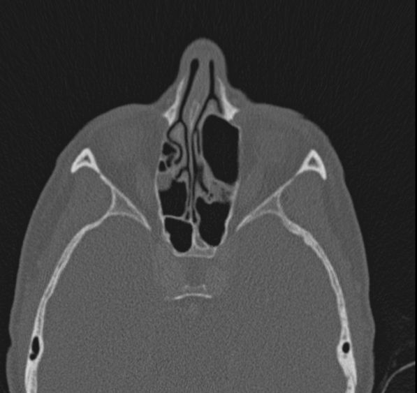 Caldwell-Luc operation (Radiopaedia 52329-58225 Axial bone window 26).jpg