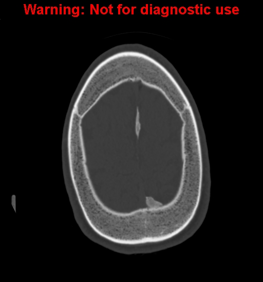 File:Calvarial thickening from chronic shunting (Radiopaedia 60079-67637 Axial bone window 158).jpg