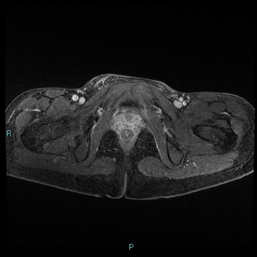 File:Canal of Nuck cyst (Radiopaedia 55074-61448 Axial T1 C+ fat sat 47).jpg