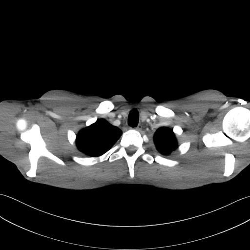 Cannonball metastases - testicular choriocarcinoma (Radiopaedia 84510-99891 B 21).jpg
