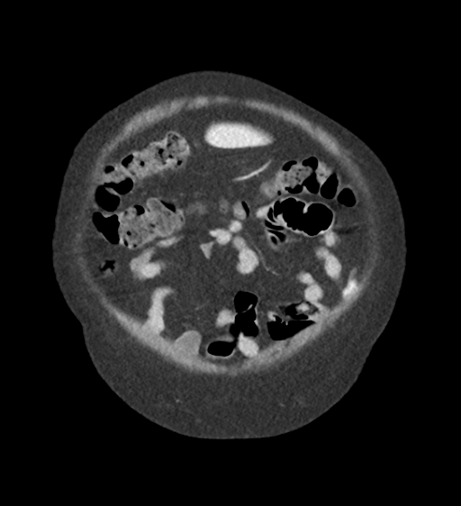 File:Cannonball metastases from endometrial cancer (Radiopaedia 42003-45031 F 12).png