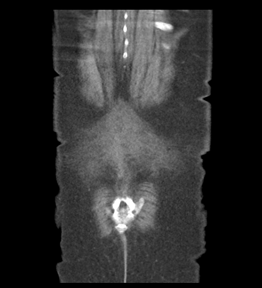 File:Cannonball metastases from endometrial cancer (Radiopaedia 42003-45031 F 59).png