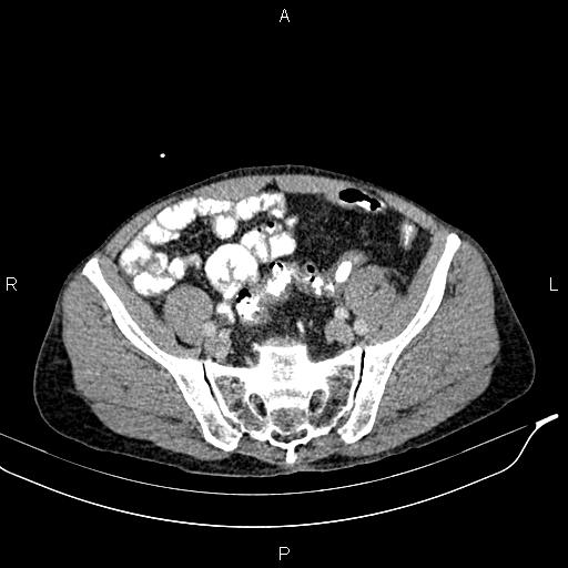Caput medusae sign - portal hypertension (Radiopaedia 64007-72759 A 77).jpg