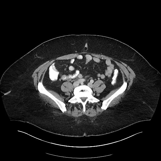 Carcinoid tumor - terminal ileum (Radiopaedia 60931-68739 A 89).jpg