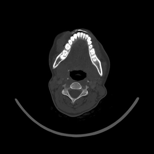 Carcinoma of the maxillary antrum (Radiopaedia 53805-59888 Axial bone window 100).jpg