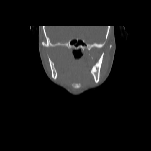Carcinoma of the maxillary antrum (Radiopaedia 53805-59888 Coronal bone window 65).jpg