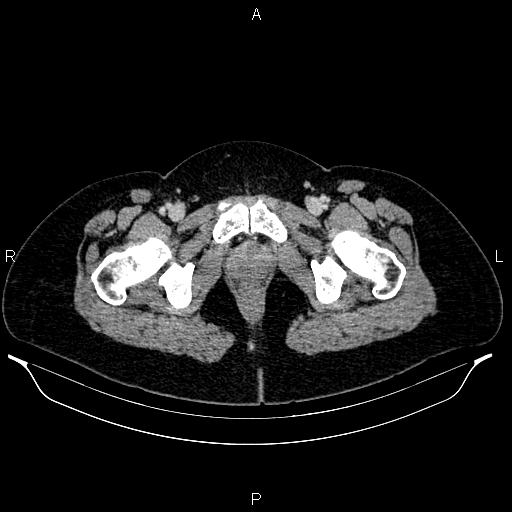 Carcinoma of uterine cervix (Radiopaedia 85861-101700 A 76).jpg