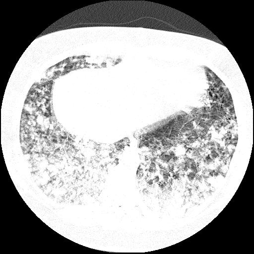 Cardiac angiosarcoma (Radiopaedia 66010-75181 Axial lung window 18).jpg