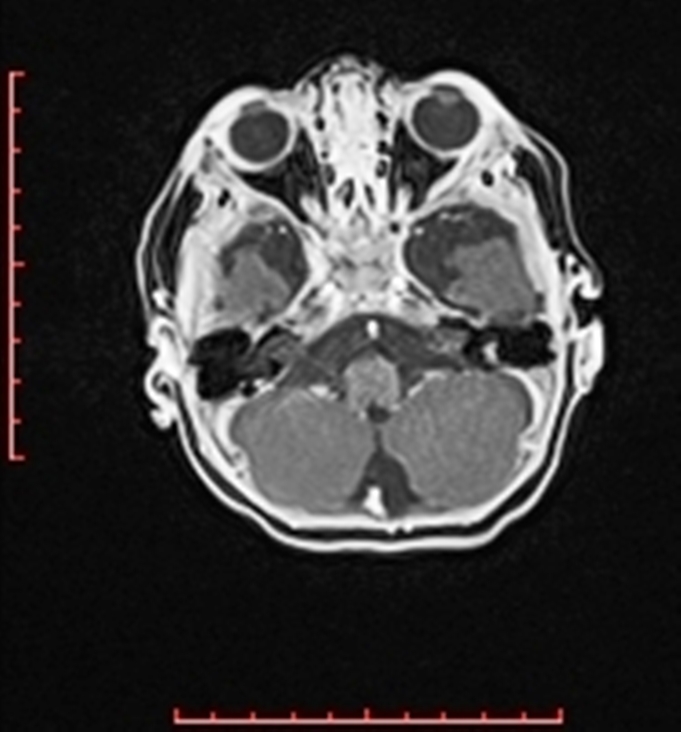 Cardiac rhabdomyoma - tuberous sclerosis (Radiopaedia 70089-80114 Axial T1 C+ fat sat 2).jpg