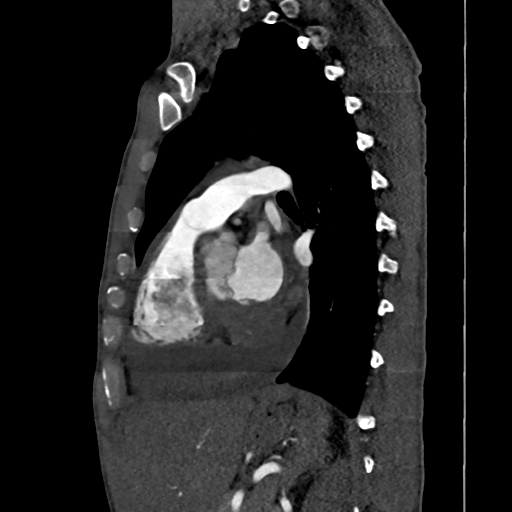 Cardiac tumor - undifferentiated pleomorphic sarcoma (Radiopaedia 45844-50134 B 30).png