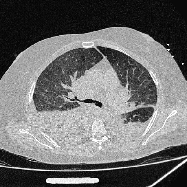 Cardiogenic pulmonary edema (Radiopaedia 29213-29609 Axial lung window 36).jpg