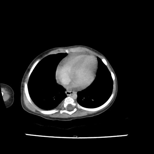 Caroli disease with autosomal recessive polycystic kidney disease (ARPKD) (Radiopaedia 89651-106703 B 5).jpg