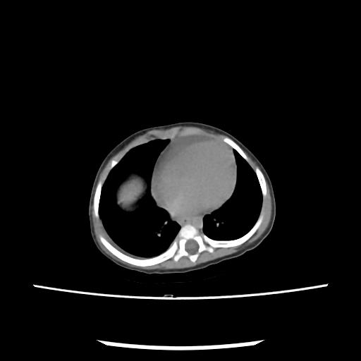 Caroli disease with autosomal recessive polycystic kidney disease (ARPKD) (Radiopaedia 89651-106703 E 5).jpg