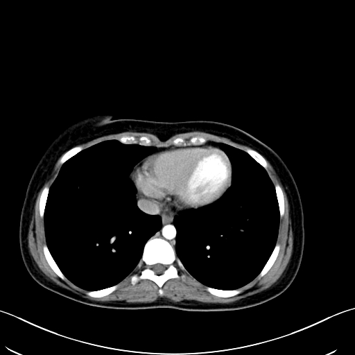 Caroli disease with medullary sponge kidney (Radiopaedia 82622-96804 C 8).jpg