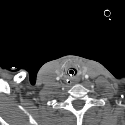 Carotid arterial dissection (Radiopaedia 30001-30548 B 37).jpg