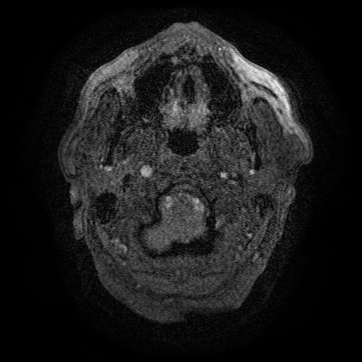 Carotid arterial dissection with acute cerebral infarction (Radiopaedia 26636-26784 MRA 171).jpg
