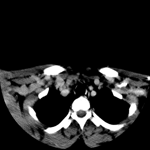File:Carotid body tumor (Radiopaedia 27890-28124 A 30).jpg