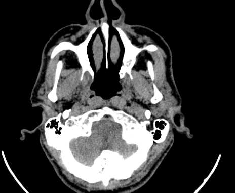 Carotid body tumor (Radiopaedia 61750-69757 Axial non-contrast 2).jpg