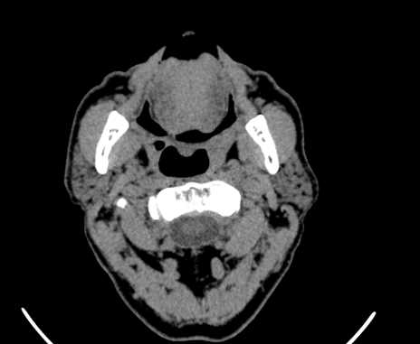 Carotid body tumor (Radiopaedia 61750-69757 Axial non-contrast 21).jpg