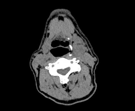 File:Carotid body tumor (Radiopaedia 61750-69757 Axial non-contrast 52).jpg