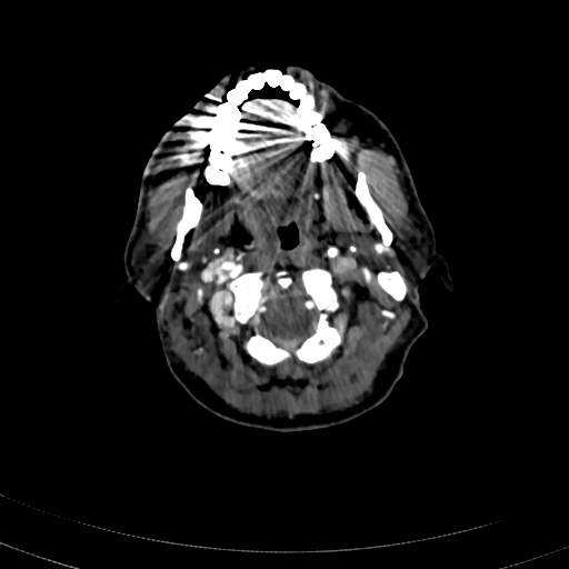 File:Carotid body tumor (Radiopaedia 83615-98727 A 34).jpg