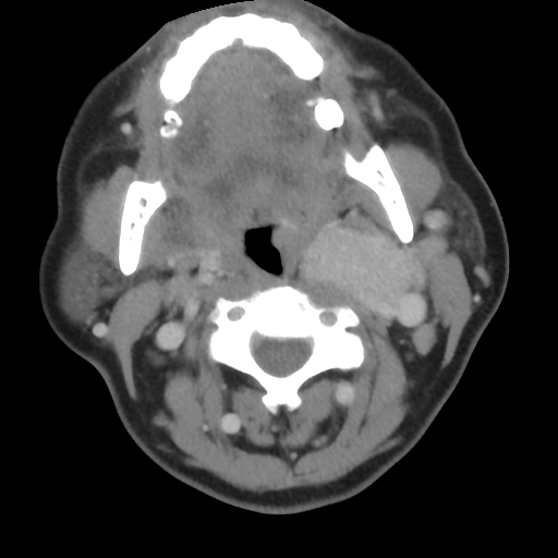 File:Carotid body tumor (paraganglioma) (Radiopaedia 38586-40729 A 14).jpg