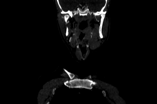 File:Carotid bulb pseudoaneurysm (Radiopaedia 57670-64616 D 1).jpg