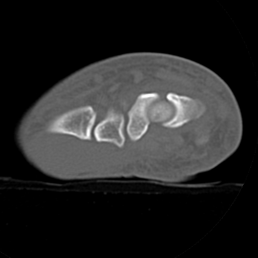File:Carpo-metacarpal fracture-dislocations with hamatum split fracture (Radiopaedia 18482-18343 Axial bone window 24).jpg