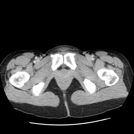 Castleman disease with fibrous pseudotumor in the abdomen (Radiopaedia 77296-89373 A 132).jpg