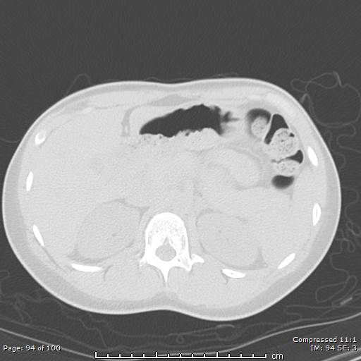 File:Catamenial pneumothorax (Radiopaedia 54382-60600 Axial non-contrast 94).jpg