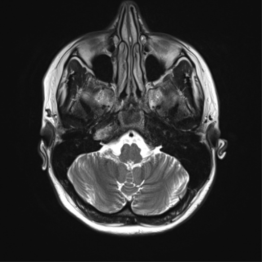 File:Cavernoma with bleed - midbrain (Radiopaedia 54546-60773 Axial T2 8).png