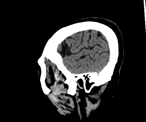 Cavernous hemangioma of the cerebellar falx (Radiopaedia 73025-83723 B 280).jpg