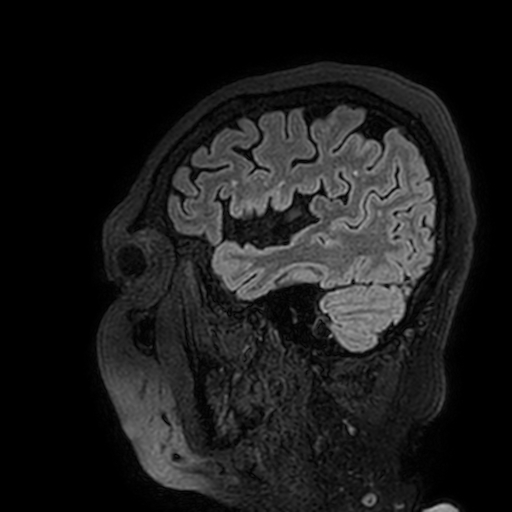 Cavernous hemangioma of the cerebellar falx (Radiopaedia 73025-83724 Sagittal FLAIR 180).jpg