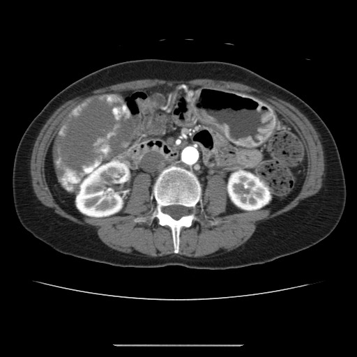 File:Cavernous hepatic hemangioma (Radiopaedia 75441-86667 A 56).jpg